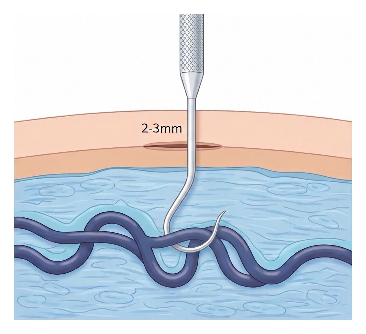 Cross-section diagram of an avulsion: a fine hook passed through a 2–3 mm skin incision lifts a varicose vein out from beneath the skin